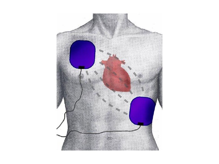 Correct AED Pad Placement First Aid For Free