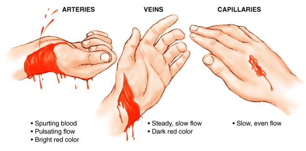 What Are The Different Types Of Bleeding In First Aid 