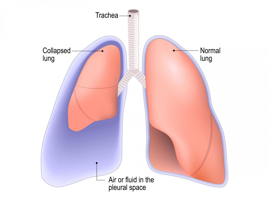 What Is A Spontaneous Pneumothorax First Aid For Free