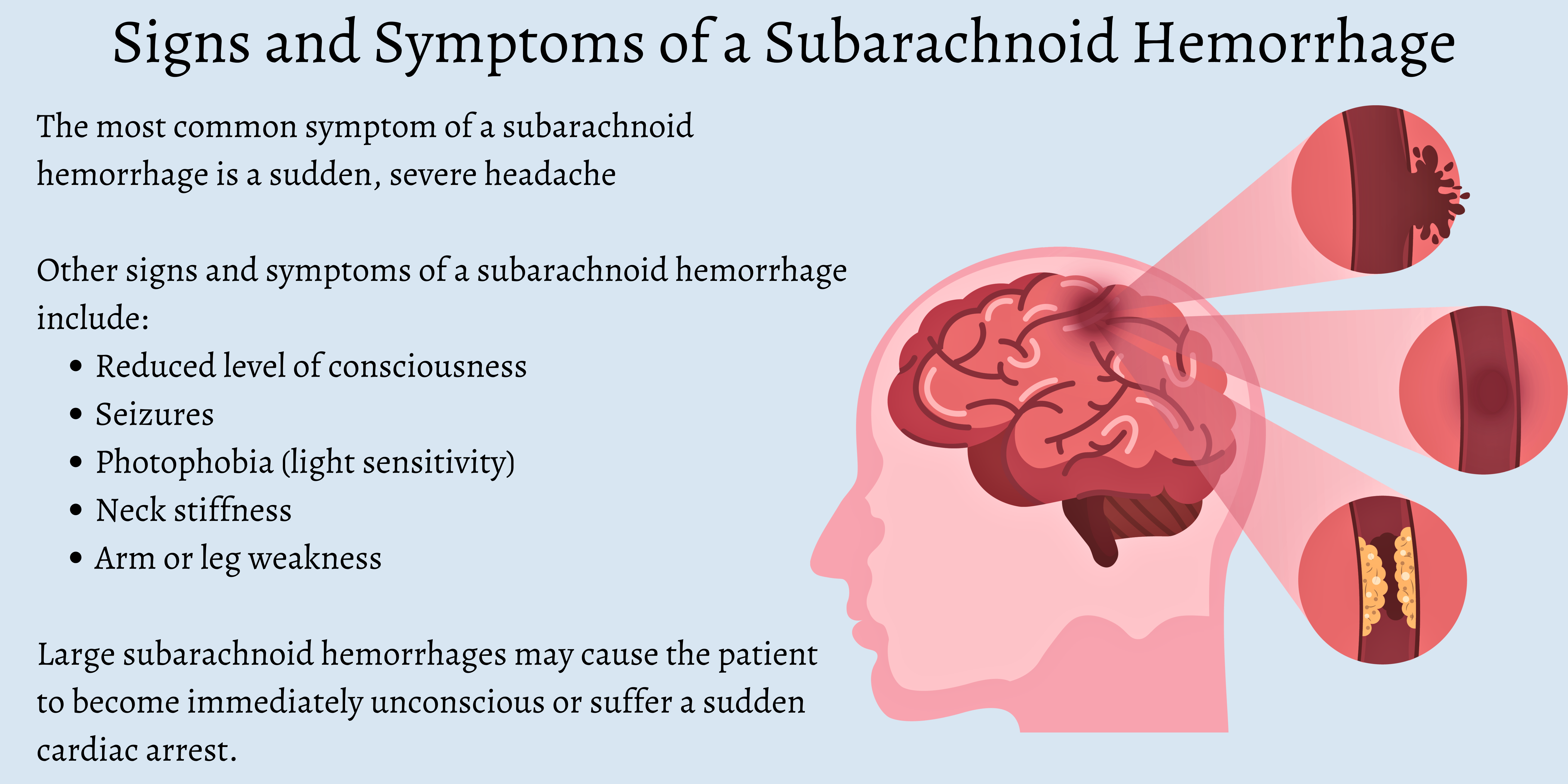 Subarachnoid Hemorrhage Symptoms & Treatment